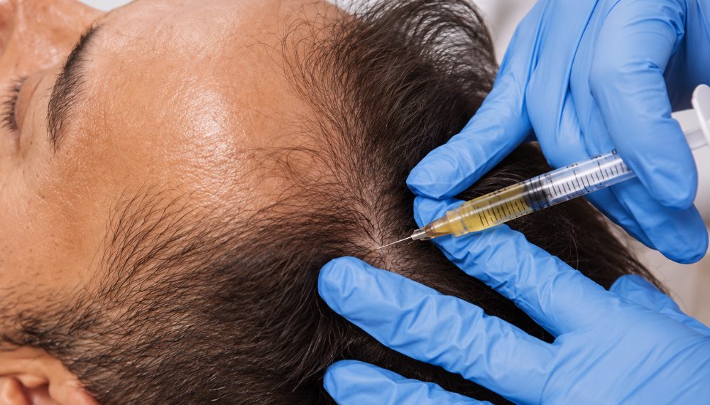 PRP and GFC for hair loss
