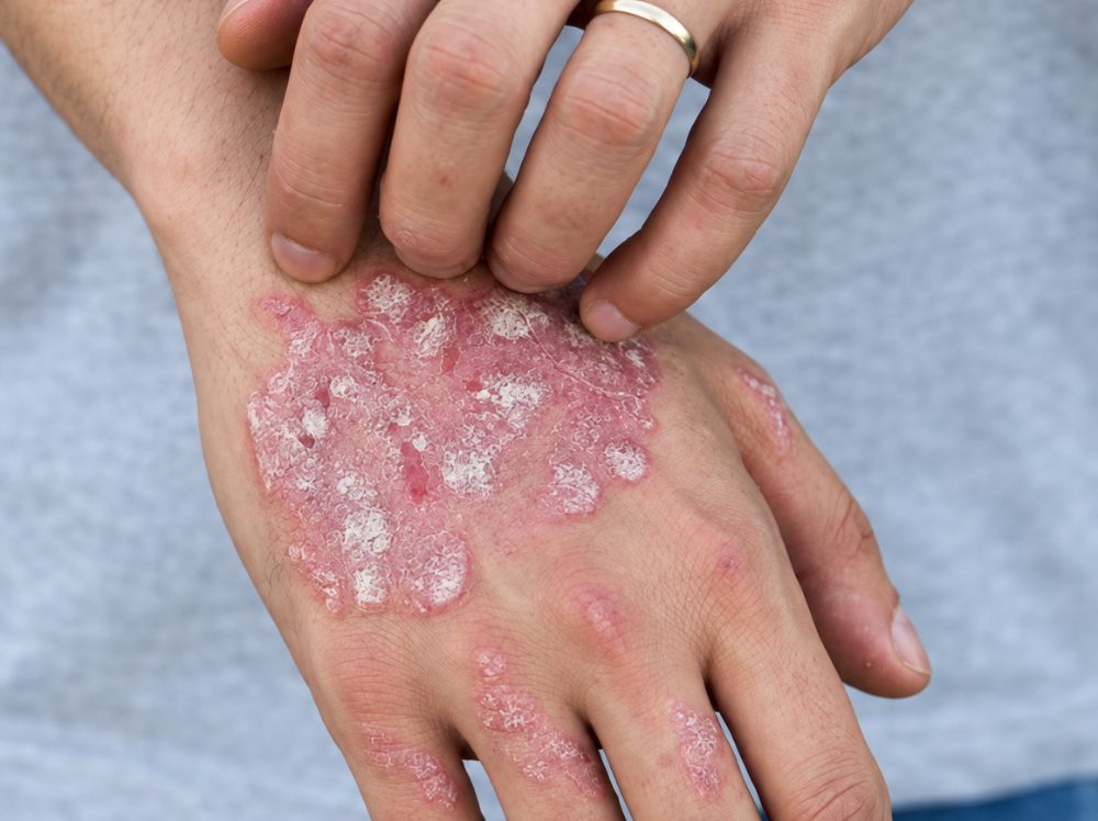 Psoriasis treatment